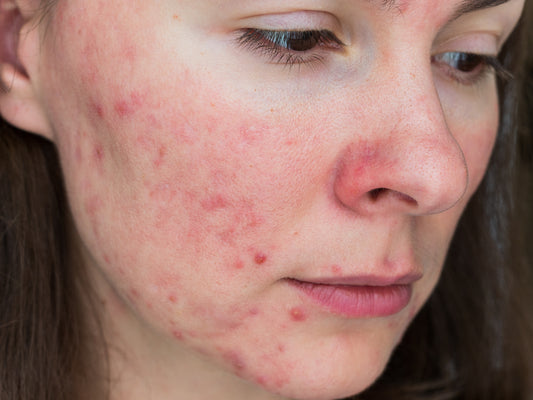 How to Manage Rosacea